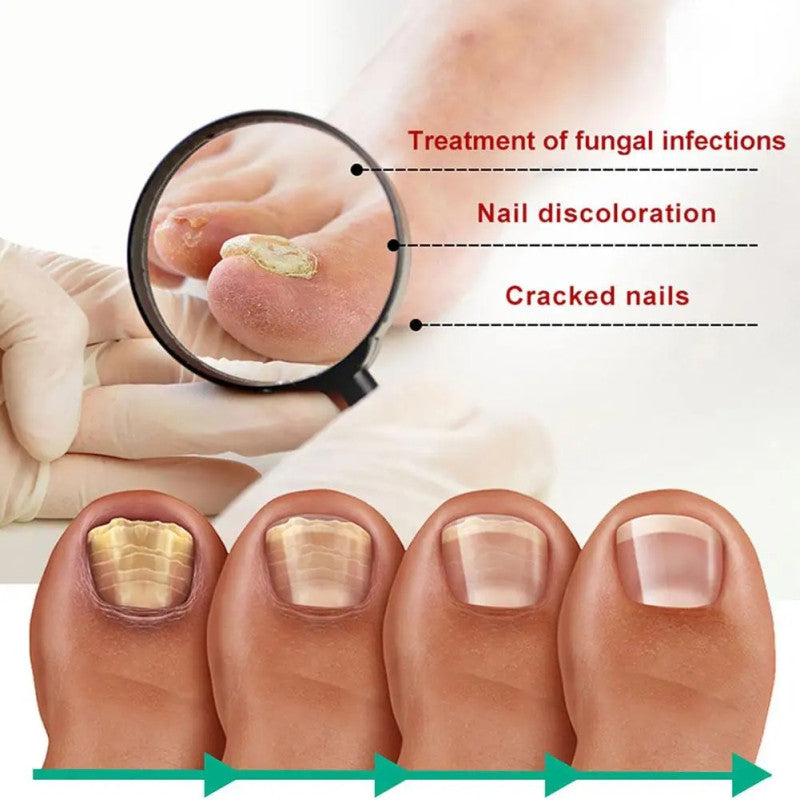 Nail Fungus Remover – Anti Fungal Nail Treatment Solution