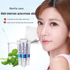 Acne Removal Cream – Anti Pimple & Dark Spot Treatment for Clear Skin
