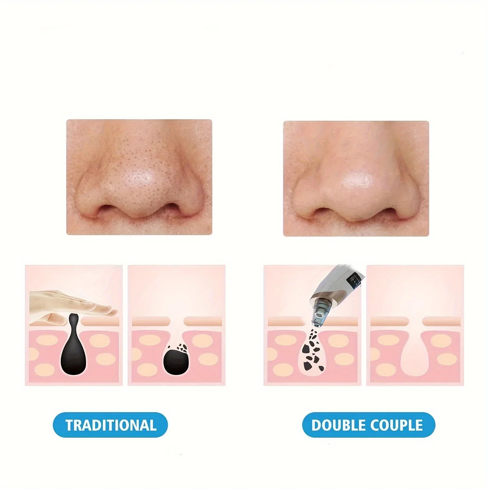 Electric Blackhead Remover Vacuum – Pore Cleaner & Acne Suction Device (5 Heads)