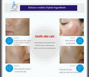 Acne Removal Cream – Anti Pimple & Dark Spot Treatment for Clear Skin