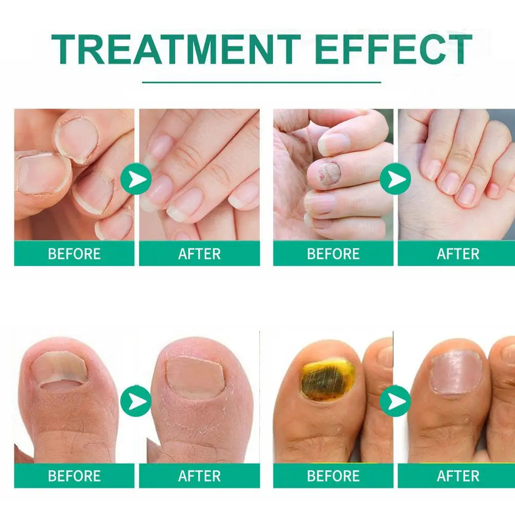 Nail Fungus Remover – Anti Fungal Nail Treatment Solution