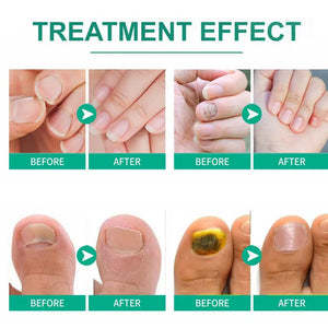 Nail Fungus Remover – Anti Fungal Nail Treatment Solution