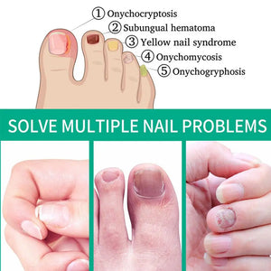 Nail Fungus Remover – Anti Fungal Nail Treatment Solution
