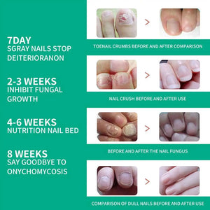 Nail Fungus Remover – Anti Fungal Nail Treatment Solution